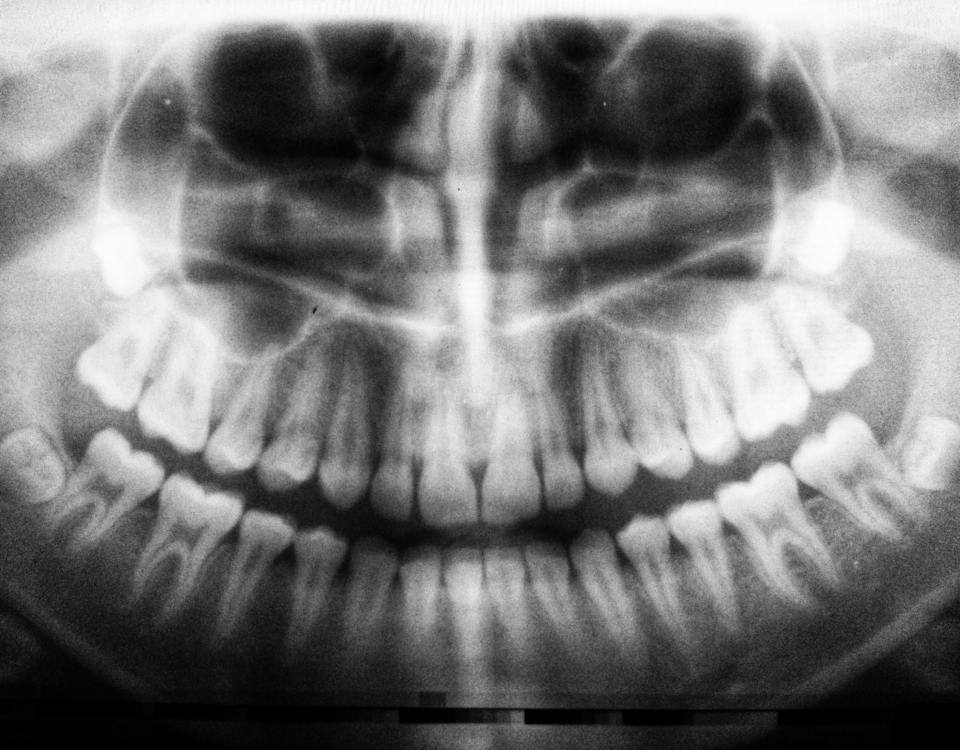 Quanto costa incapsulare un dente