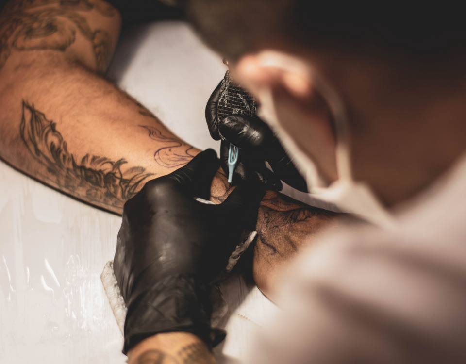 Quanto costa rimuovere un tatuaggio