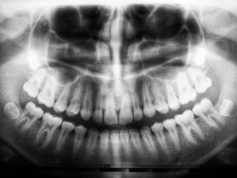 Quanto costa uno sbiancamento dentale