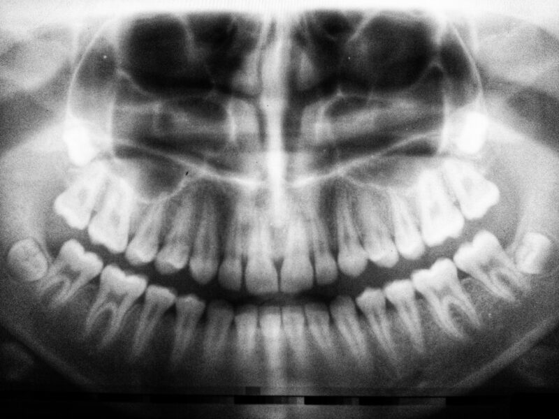 Quanto costa ricostruire un dente