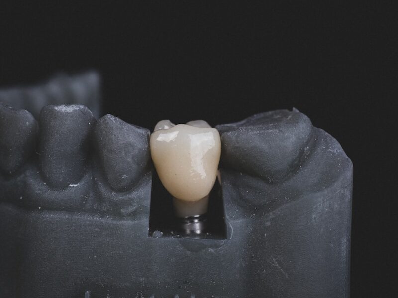 Quanto costa impiantare un dente